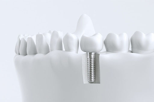 Implantes dentales 2